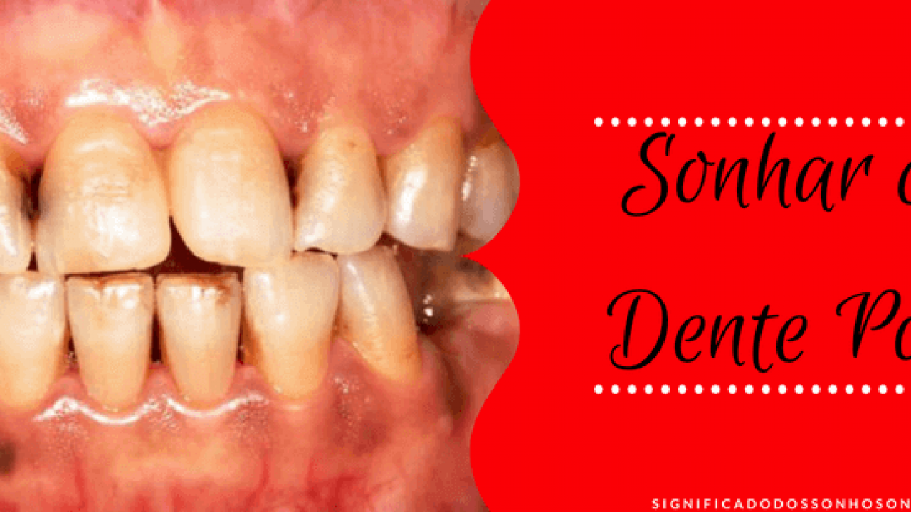 Featured image of post Imagens De Dente Podre Com Bicho - Os dentes deles são bem estranhos, diferentes das pessoas, os dentes ficam mais fortes quando corroídos.
