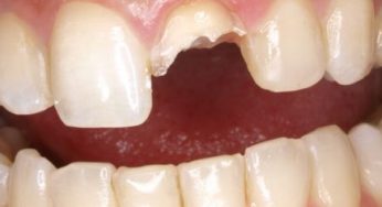 ▷ Sonhar Com Dente Quebrado -【IMPRESSIONANTE】