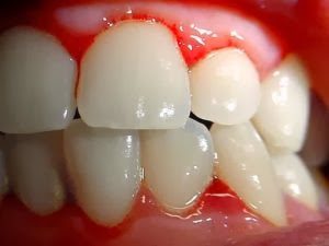 Leia mais sobre o artigo ▷ Sonhar com Dente Sangrando【IMPERDÍVEL】