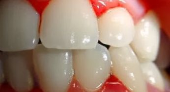 ▷ Sonhar com Dente Sangrando【IMPERDÍVEL】
