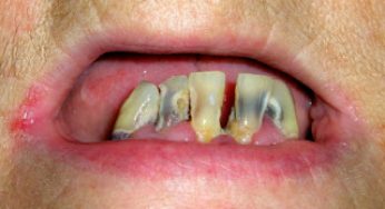 ▷ Sonhar com dente cariado【IMPERDÍVEL】