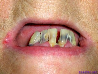 No momento, você está visualizando ▷ Sonhar com dente cariado【IMPERDÍVEL】