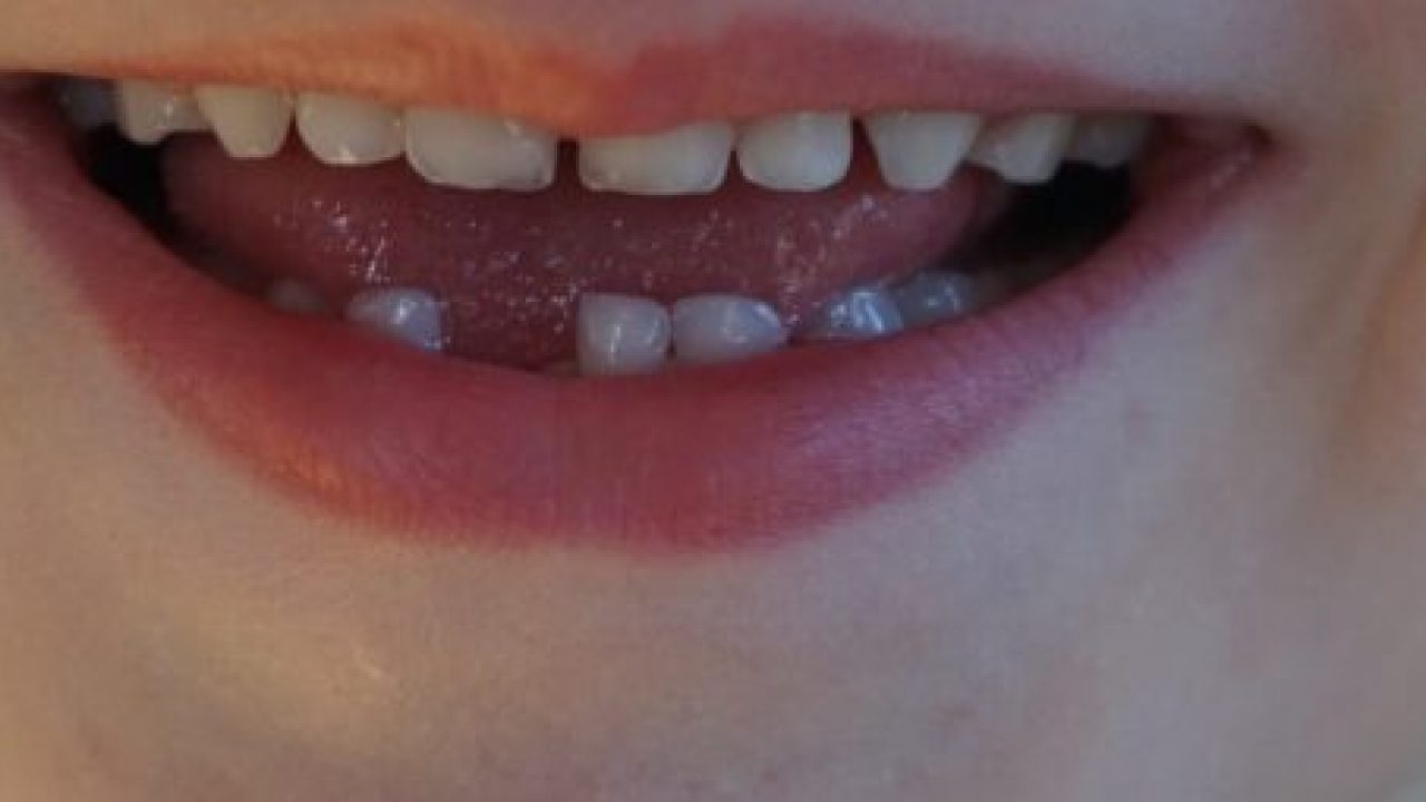 Featured image of post Sonhar Com Dente Encavalado Sonhar com dente caindo na boca de um amigo pode significar uma mentira dita por esta pessoa muito s ria