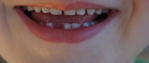 Leia mais sobre o artigo ▷ Sonhar com Dente Nascendo【INTERPRETAÇÃO REVELADORA】