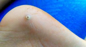 Leia mais sobre o artigo ▷ Sonhar Com Bicho De Pé 【Não se assuste com os significados】