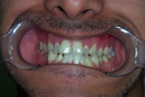 Leia mais sobre o artigo ▷ Sonhar Com Dente Torto – Significados Reveladores
