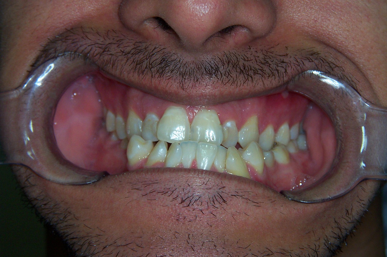 Featured image of post Sonhar Com Dente Torto Por isso pra entender o significado de sonhar com dente