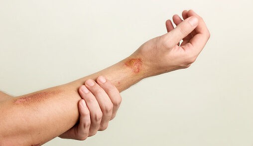 pessoa com uma ferida na mão