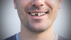 Leia mais sobre o artigo Sonhar com dente quebrado da frente – Significa o quê?
