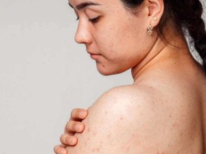 Leia mais sobre o artigo Sonhar com espinhas no corpo