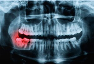Leia mais sobre o artigo  9 Significados espirituais dos dentes do siso
